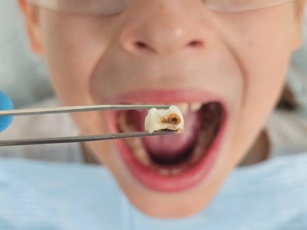 Best Chipped Tooth Repair Near Me  in Mount Hope, NJ